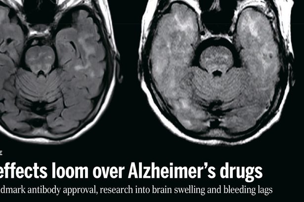 重い副作用への懸念強く　アルツハイマー病薬「レカネマブ」