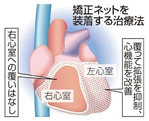 心臓　ネットで覆い機能改善／名古屋大／難病の新治療法、２７年実用化へ