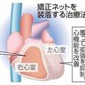 心臓　ネットで覆い機能改善／名古屋大／難病の新治療法、２７年実用化へ