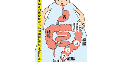 〈ドクターのゆんたくひんたく〉161　直腸手術後の排便障害　時間経過、訓練で改善