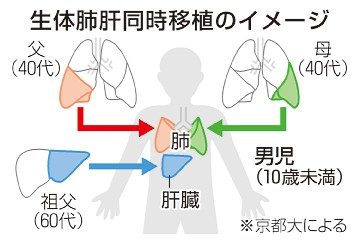 肺と肝臓、同時生体移植　京大病院　男児に両親と祖父提供